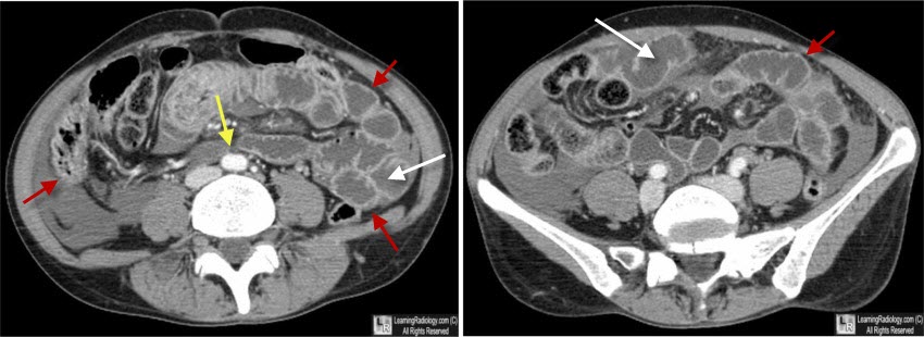 shock bowel, ct hypotensive complex